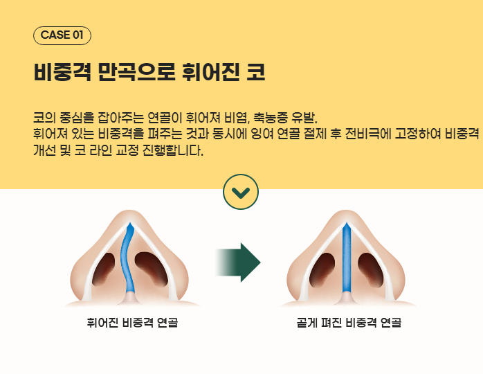 실비 적용되는 예쁜 코, 기능코성형 관련 이미지 2