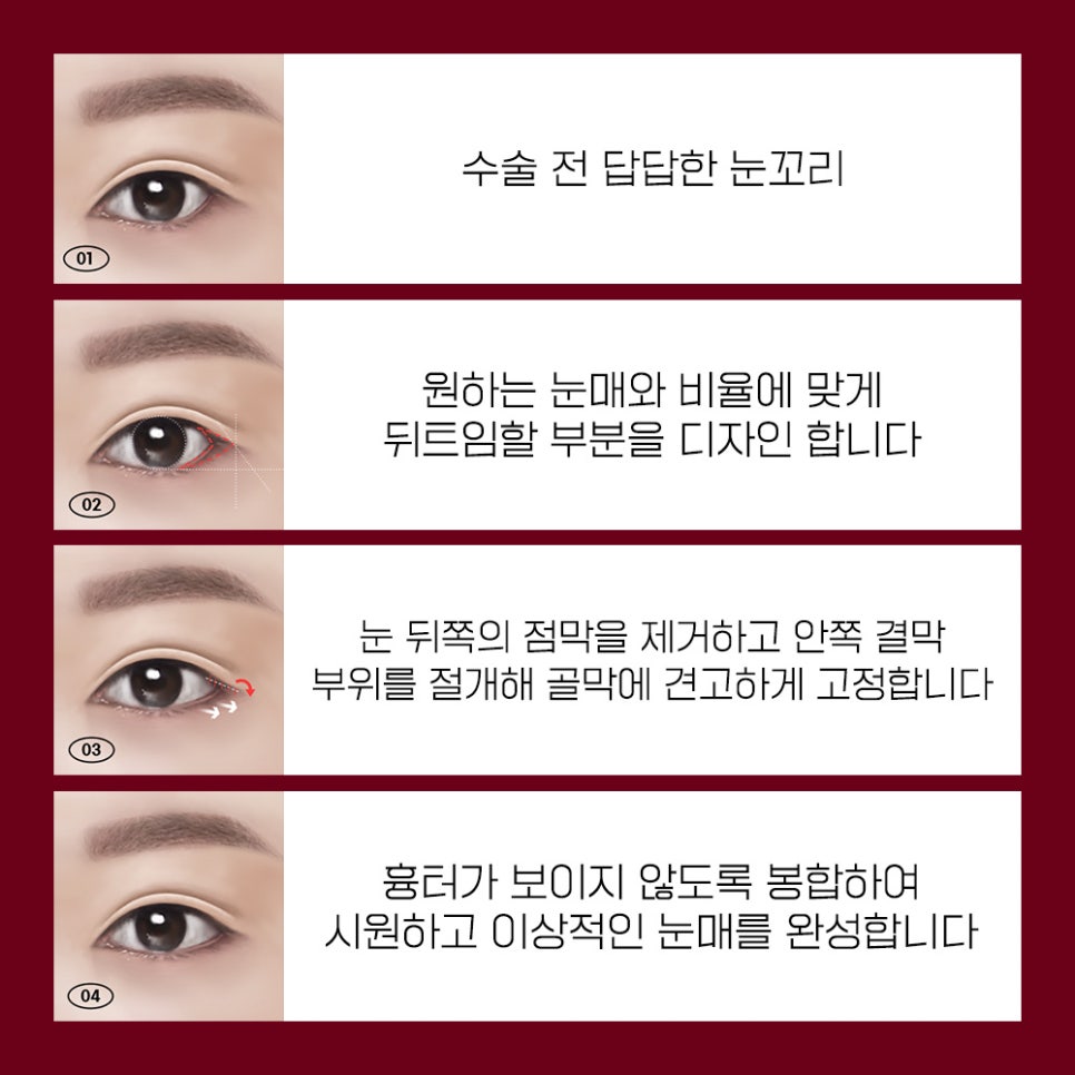 나에게 맞는 트임 성형으로 크고 또렷한 눈매로 개선 관련 이미지 5