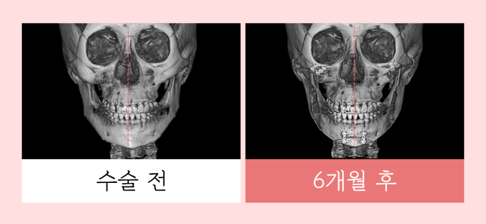 윤곽 재수술의 다양한 원인과 개선 방법! 관련 이미지 6