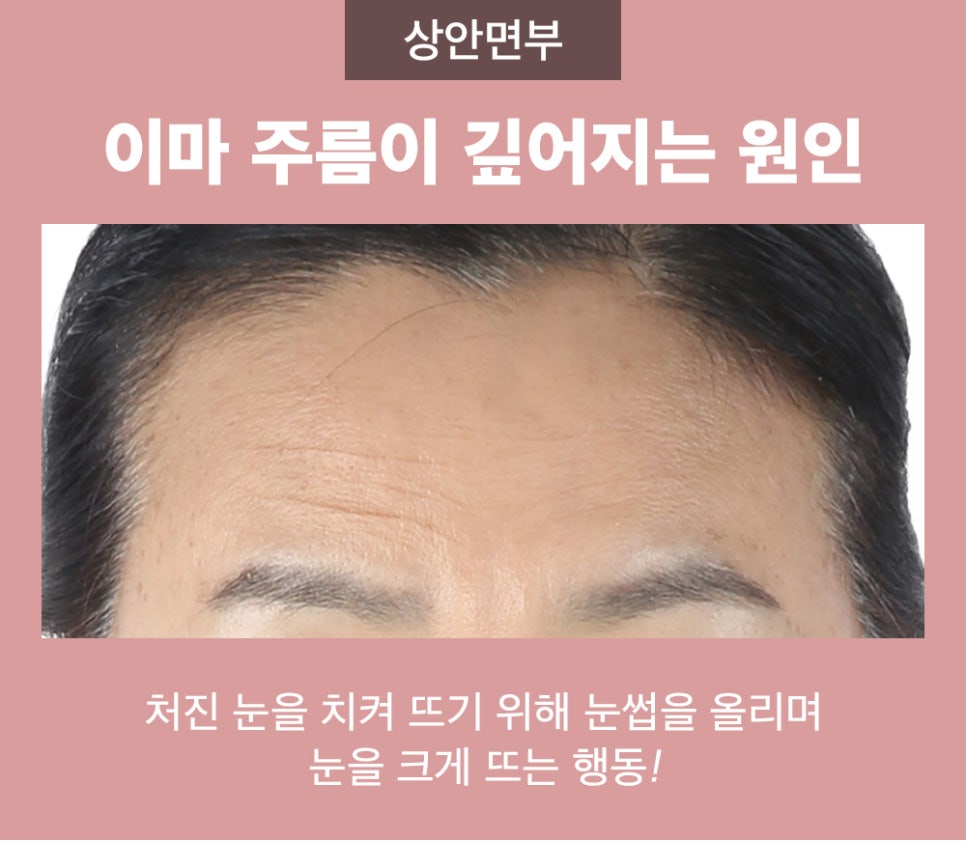 엔도타인 이마 리프팅이 필요한 경우와 수술 방법 관련 이미지 2