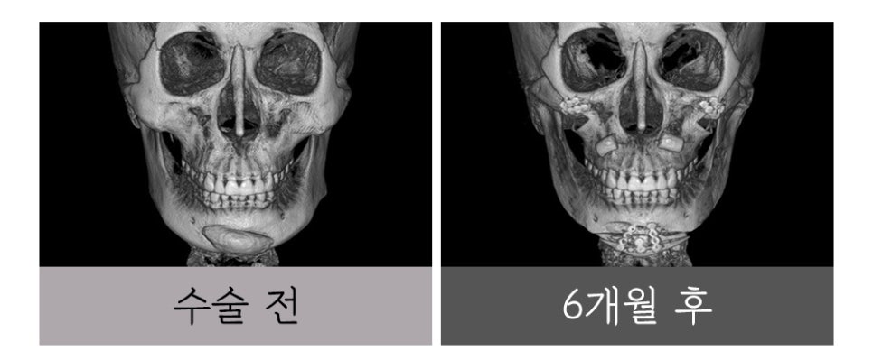 윤곽 재수술, 정밀한 진단과 치밀한 설계로 바로잡아야 합니다. 관련 이미지 7