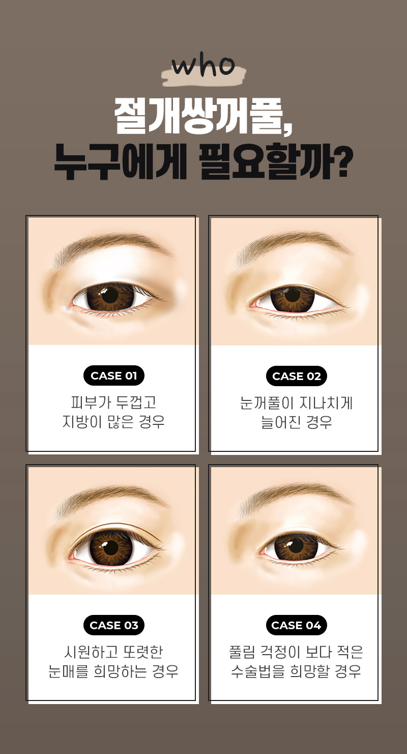 절개 쌍꺼풀의 수술법과 절개법이 필요한 경우 관련 이미지 4