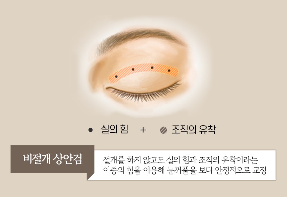 노화로 인한 눈꺼풀 처짐, 바노바기 비절개 상안검으로 개선! 관련 이미지 3