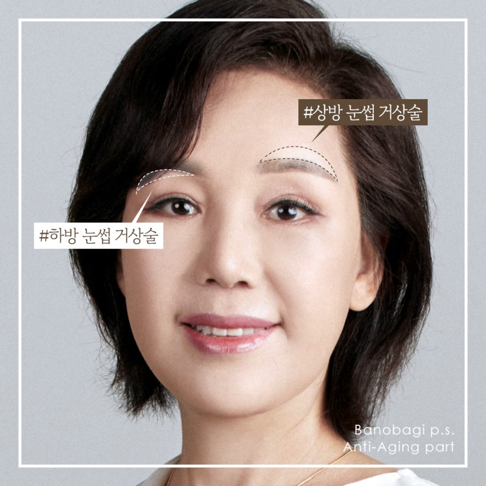눈가 처짐 개선, 눈썹 거상술의 장점과 수술 방법 관련 이미지 2