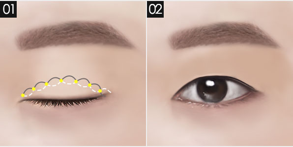 남자 눈 성형, 자연스럽고 또렷한 인상으로! 관련 이미지 3