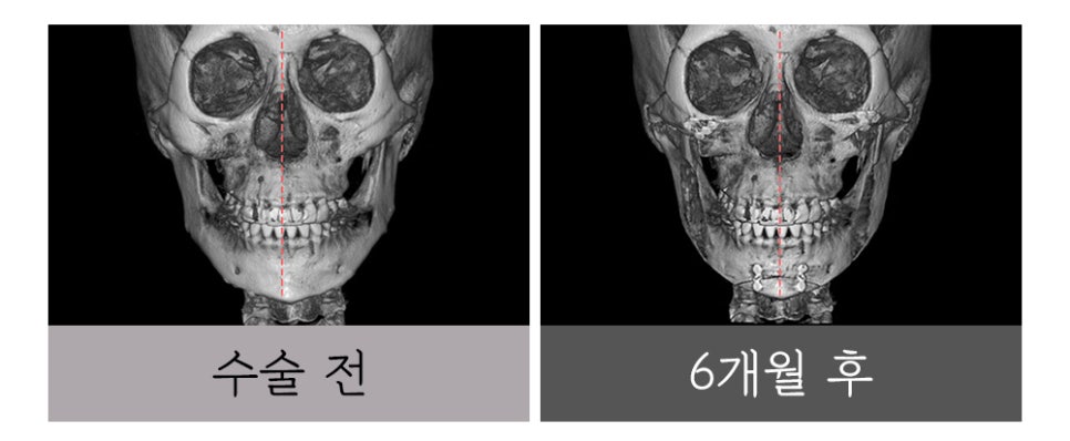 윤곽 재수술, 정밀한 진단과 치밀한 설계로 바로잡아야 합니다. 관련 이미지 8