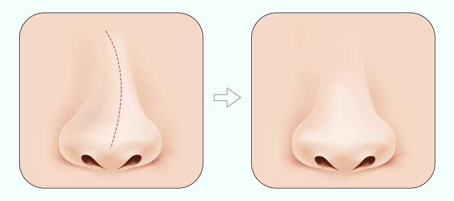 코 재수술! 원인에 따라 달라지는 수술법 관련 이미지 7