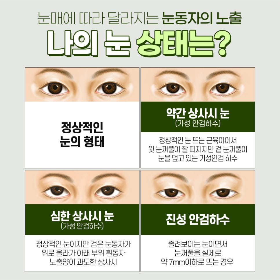 눈매교정 수술법, 절개 vs 비절개 나에게 맞는 수술법은? 관련 이미지 2