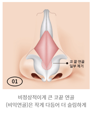 통통하고 뭉툭한 코, 슬림하고 오똑하게! 복코 성형 관련 이미지 3