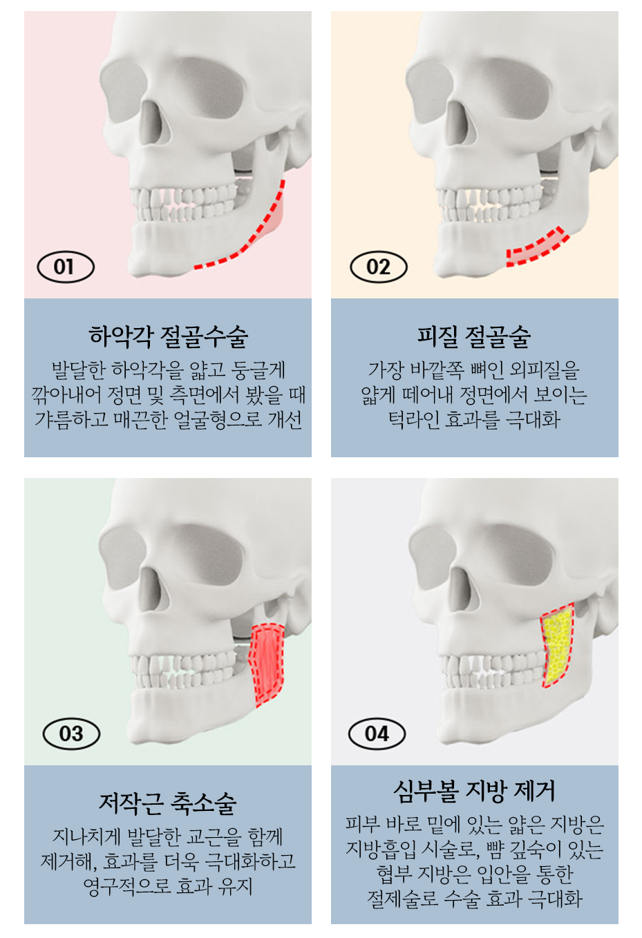 사각턱 수술, 획일화된 V라인 대신 나에게 맞는 라인으로 관련 이미지 3