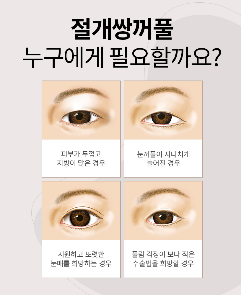 절개 쌍꺼풀 수술도 매몰처럼 자연스러운 라인이 가능한 이유! 관련 이미지 3
