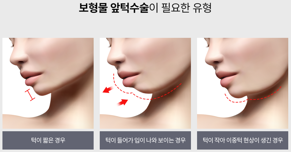 입체감 있고 또렷한 윤곽 라인의 비결은? 보형물 앞턱수술 관련 이미지 2