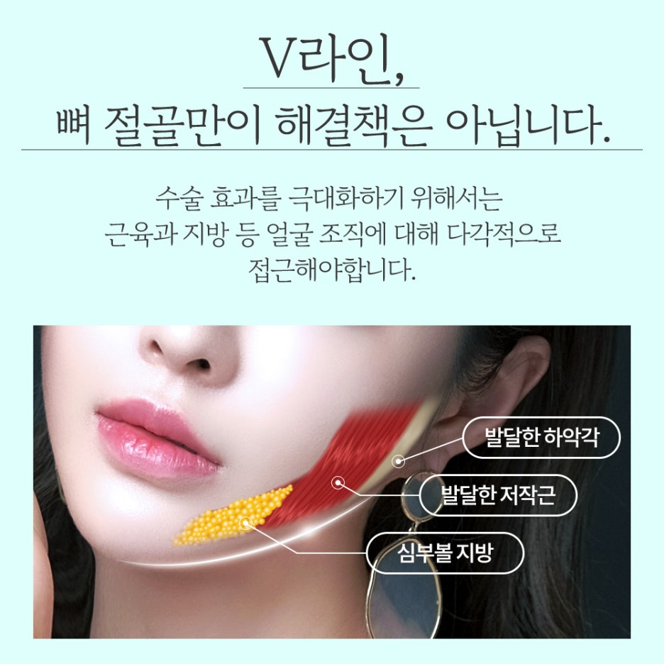 사각턱 수술 방법이 나뉘는 이유와 나에게 맞는 수술법은? 관련 이미지 2