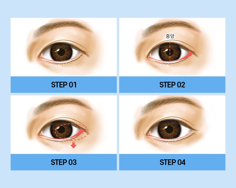 매력적인 눈매! 트임 성형만으로도 개선할 수 있습니다. 관련 이미지 5