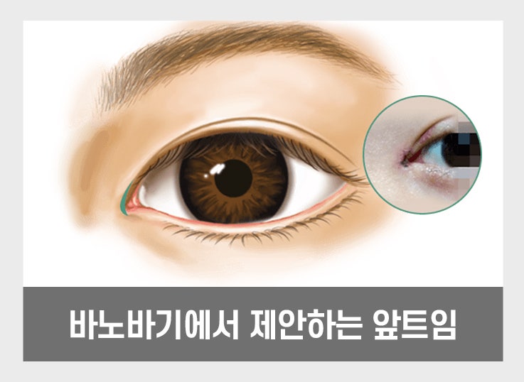 답답한 눈매를 또렷하고 시원하게 개선할 수 있는 트임 성형 방법! 관련 이미지 3