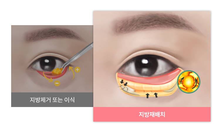 볼록하고 어두운 눈밑 정리하기! 눈밑지방재배치 관련 이미지 3