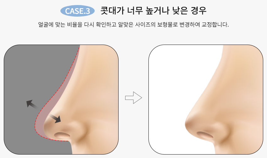 마지막 코재수술, 바노바기에서! 관련 이미지 5