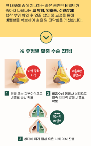 바노바기 기능코 수술 실비 적용으로 코 질환 개선과 예쁜 콧대까지! 관련 이미지 3