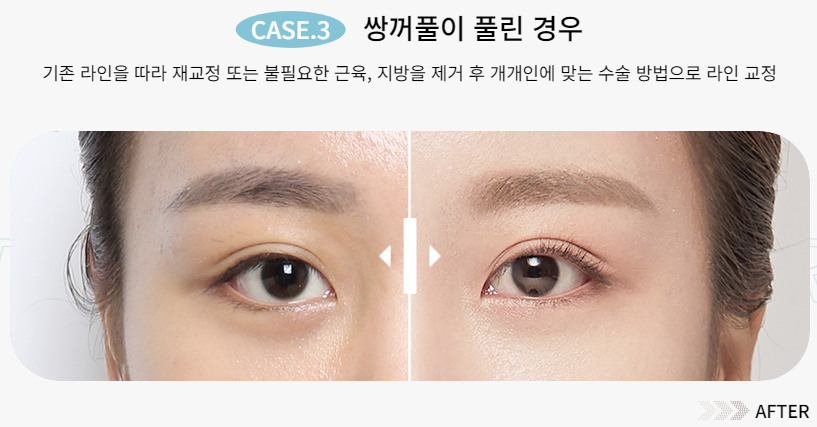 예쁜 눈매를 되찾는 방법, 눈 재수술 관련 이미지 5