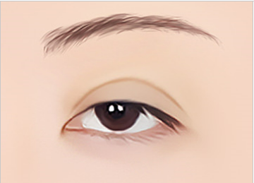 눈 재수술은 어떤 경우에 하는 걸까? 관련 이미지 4