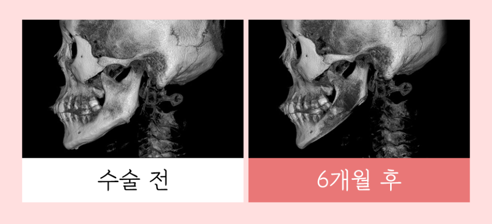 윤곽 재수술의 다양한 원인과 개선 방법! 관련 이미지 4