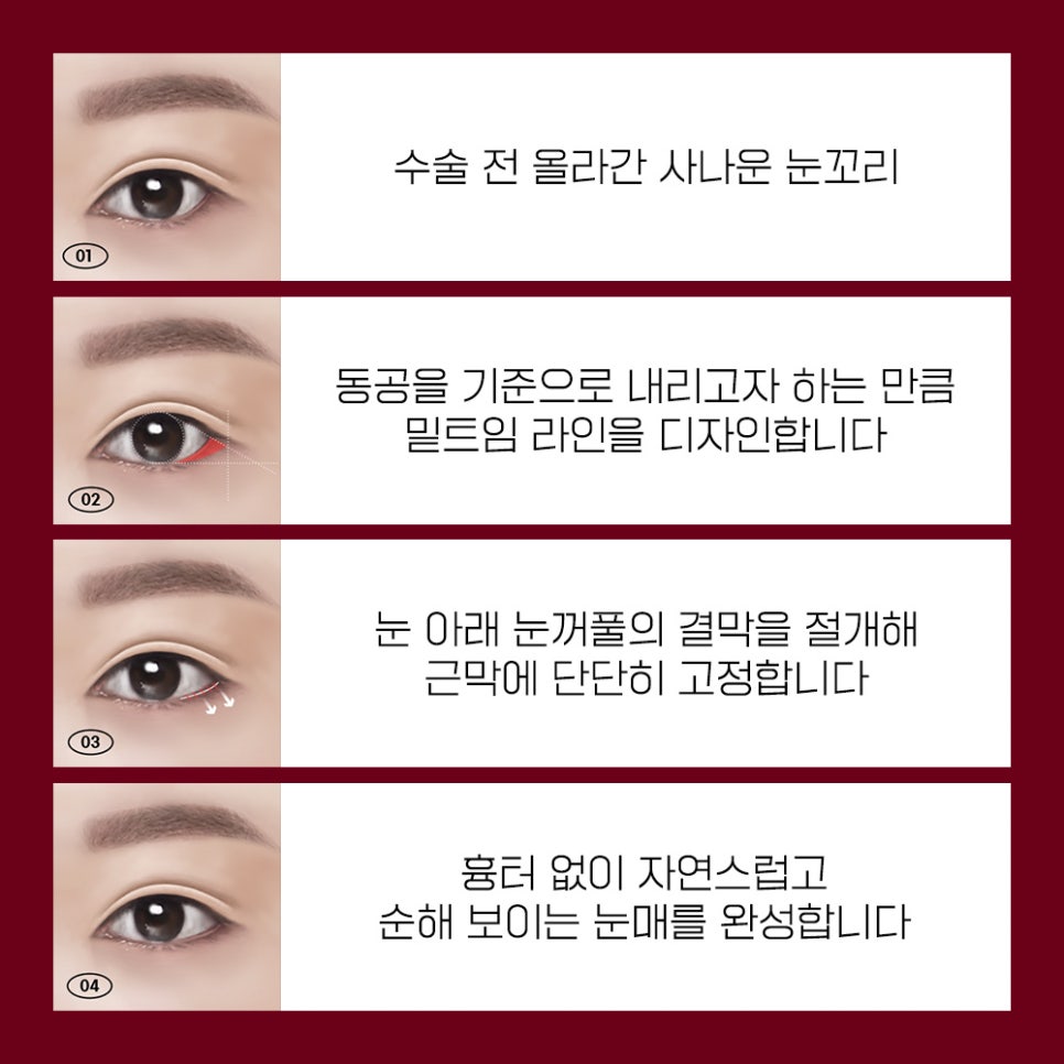 나에게 맞는 트임 성형으로 크고 또렷한 눈매로 개선 관련 이미지 7