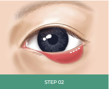 눈 밑 주름, 다크서클 눈 밑 지방재배치로 개선할 수 있습니다. 관련 이미지 5