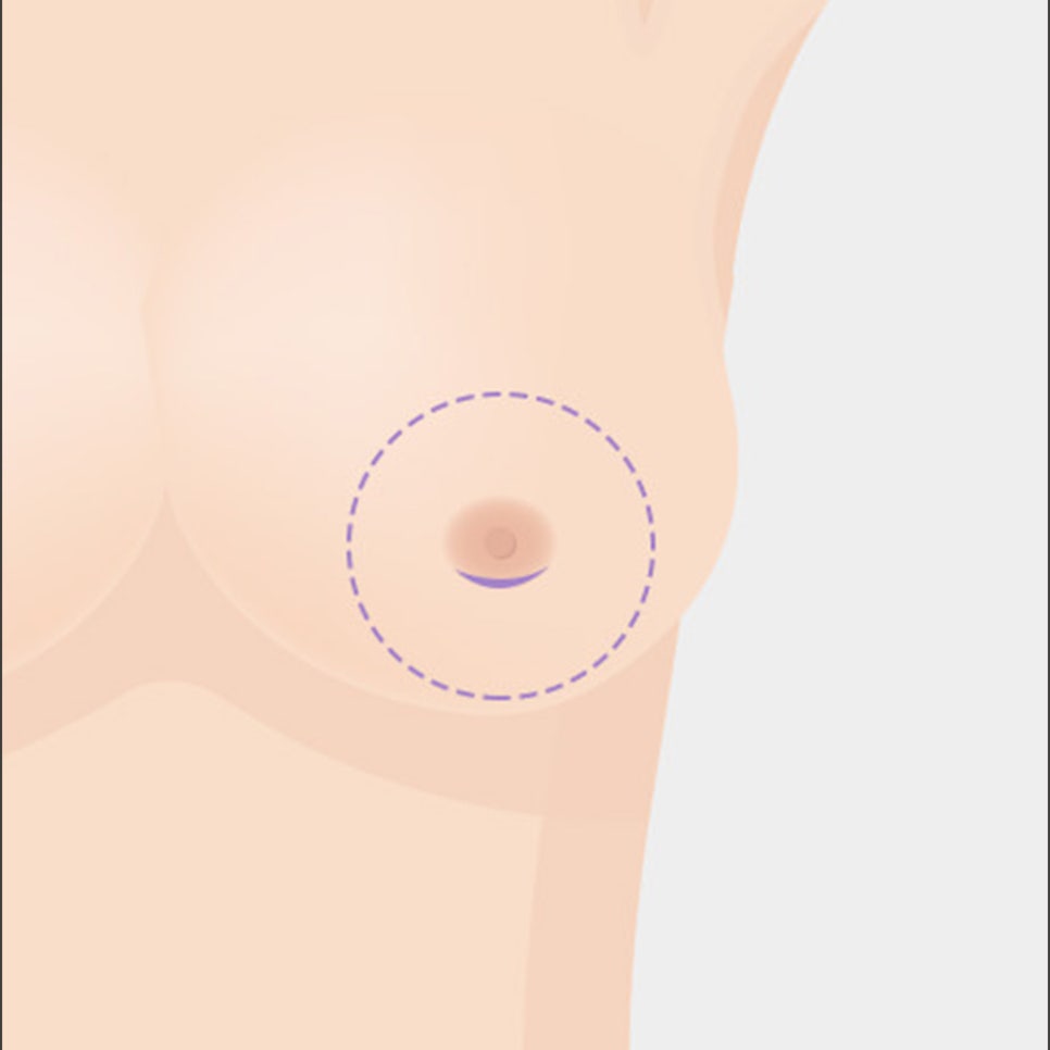 가슴 성형, 보형물의 종류와 절개법의 장단점 관련 이미지 14