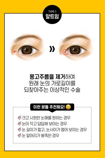 트임성형은 내 얼굴에 맞게 조화로운 비율로! 관련 이미지 3