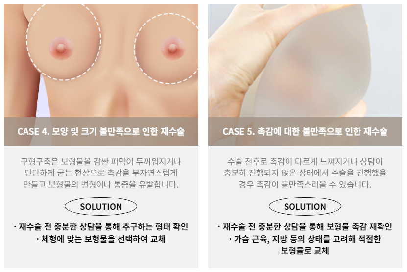 더 이상 추가 수술 없이 아름답게, 가슴 재수술 관련 이미지 4