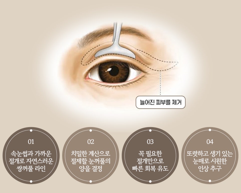 노화로 인한 눈꺼풀 처짐, 바노바기 비절개 상안검으로 개선! 관련 이미지 5