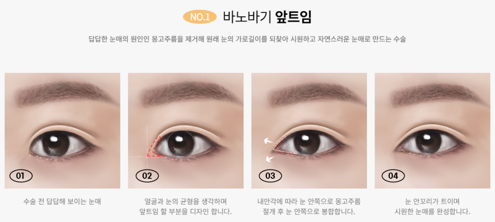 내 눈의 숨겨진 1mm를 찾아내다! 바노바기 트임성형 관련 이미지 3