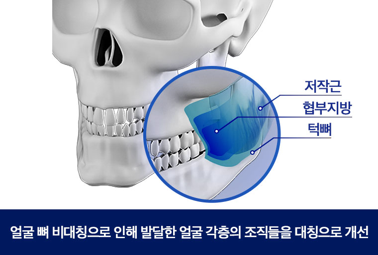 안면비대칭, 정확한 원인 분석으로  한 번에 개선 관련 이미지 5