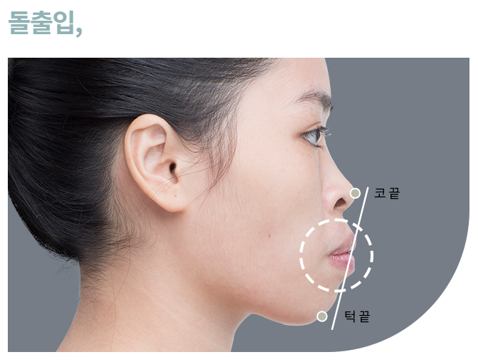 돌출 입, 쏙 집어넣는 방법! 관련 이미지 2