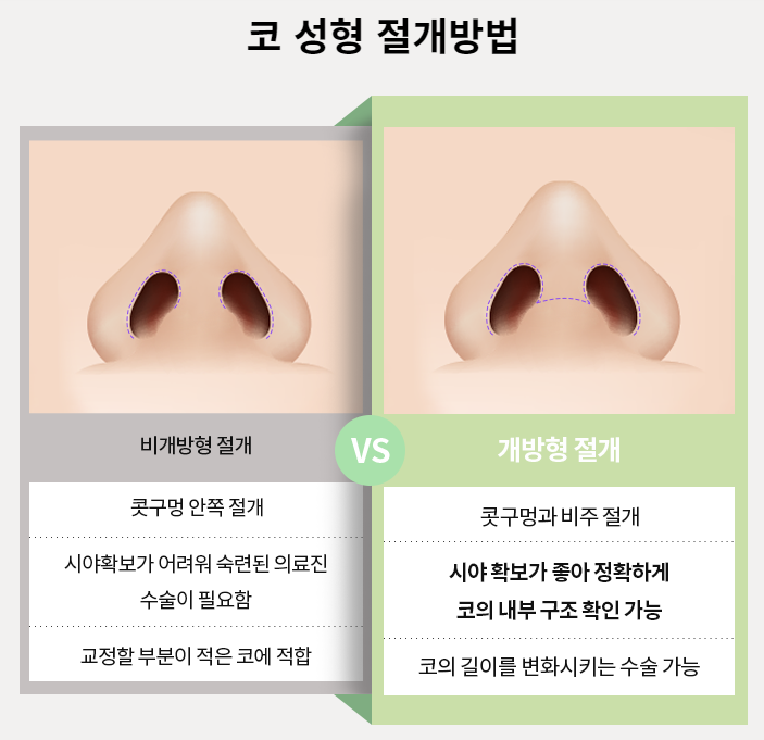 낮은 코 성형으로 입체감 있는 얼굴을! 관련 이미지 4