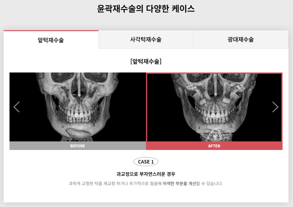 다시 되찾는 아름다운 미소! 윤곽재수술 관련 이미지 2