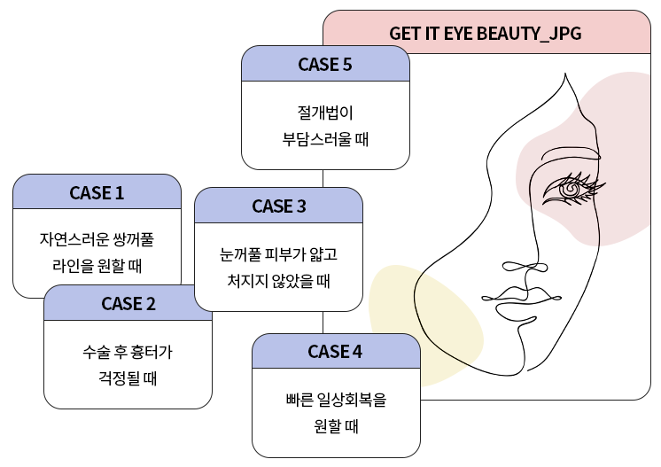 자연스러움의 끝판왕! 이중매몰 쌍꺼풀 관련 이미지 2