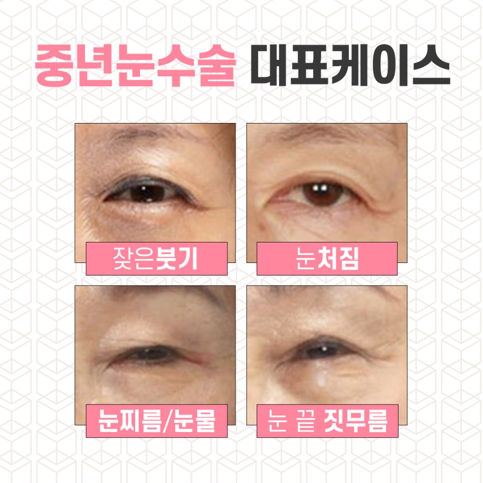 중년눈수술 상안검 만족도 높은 결과를 위해서는? 관련 이미지 2