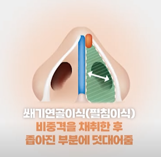 비밸브협착증, 코 막힘의 원인은? 관련 이미지 5