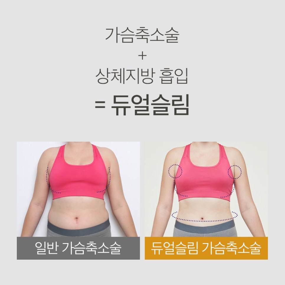 가슴 축소술, 미용적 개선과 신체 균형까지 동시에 개선 관련 이미지 7