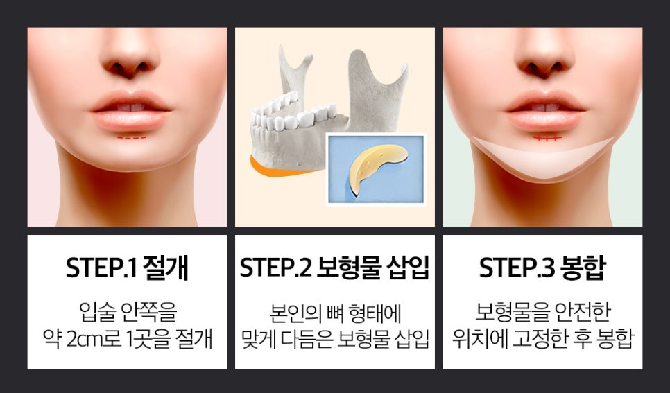 앞턱 보형물 교정이 필요한 경우와 수술 방법 관련 이미지 3