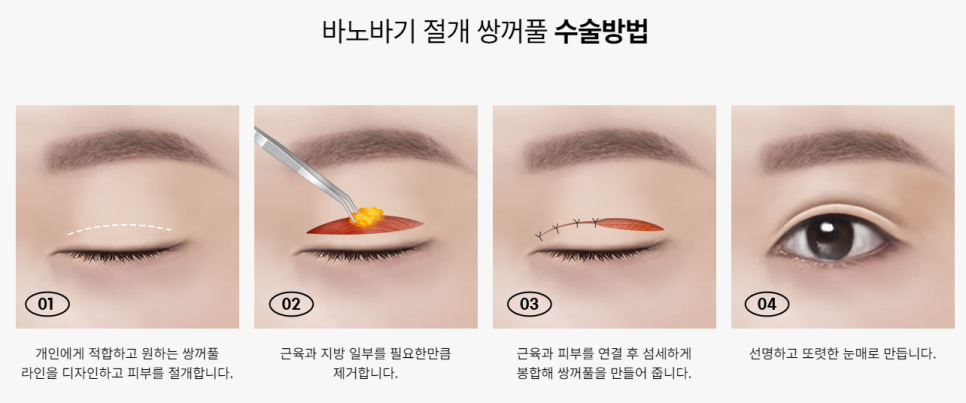 매몰만큼 자연스러운 절개 쌍꺼풀! 관련 이미지 2