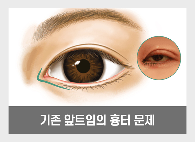 답답한 눈매를 또렷하고 시원하게 개선할 수 있는 트임 성형 방법! 관련 이미지 2