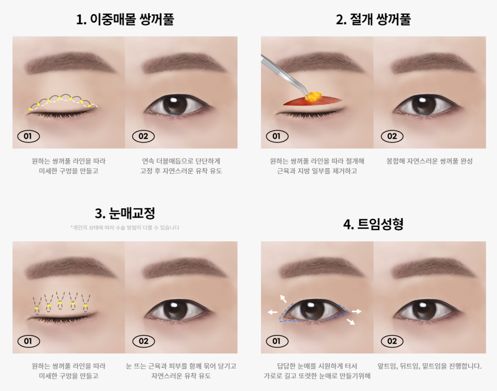 자연스럽지만 또렷한 &lsquo;남자 눈성형&rsquo; 관련 이미지 4