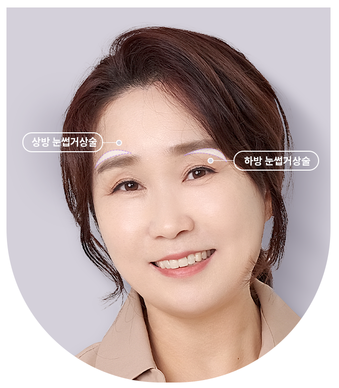 자연스럽게 눈가 처짐을 개선하는 바노바기 눈썹거상술! 관련 이미지 2