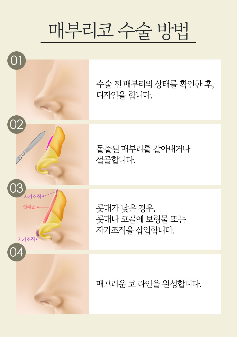 굴곡진 콧대, 매부리코 성형으로 자연스럽고 매끄럽게 개선 관련 이미지 3