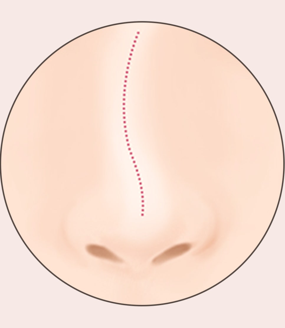 코 재수술의 다양한 원인과 개선 방법! 관련 이미지 9