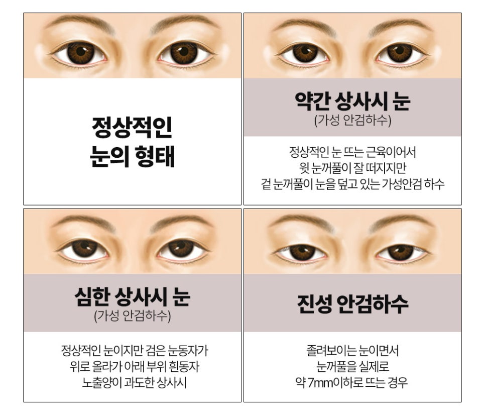 또렷한 눈매로 개선 가능한 눈매교정 정확한 진단이 중요! 관련 이미지 2