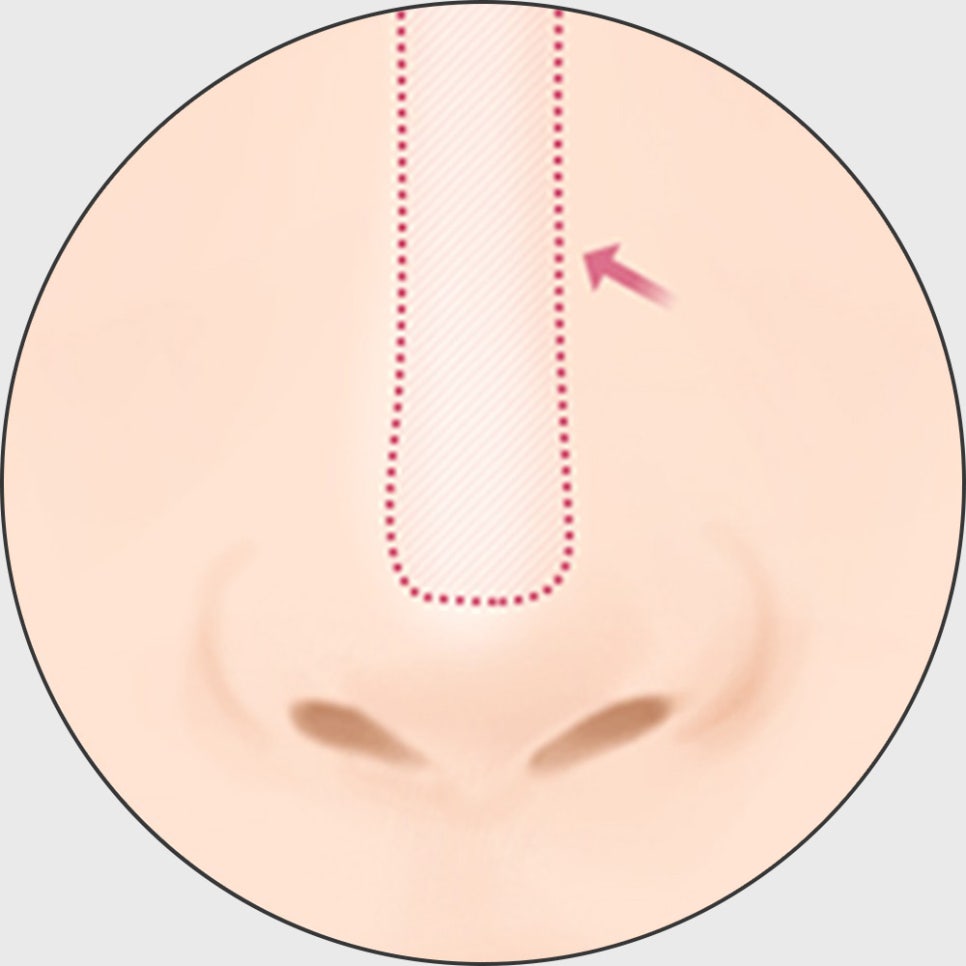 코 재수술, 적합한 시기에 원인에 따른 올바른 방법으로 개선해야 합니다! 관련 이미지 10