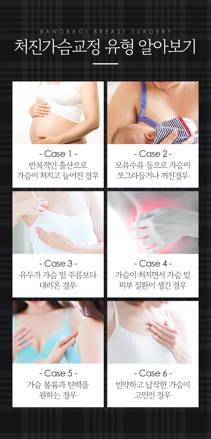 나도 처진 가슴일까? 유형에 따른 수술법과 개선 방법 관련 이미지 2